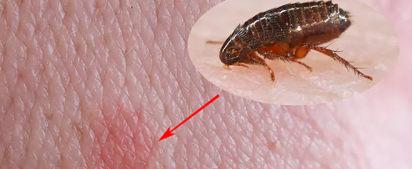 Flea Control for Humans Santa Ana, CA